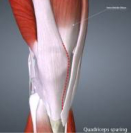 artrotomia con risparmio del quadricipite, tecnica minivasiva protesi di ginocchio
