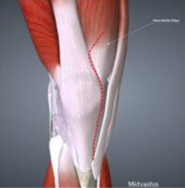 artrotomia midvastus tecnica minivasiva protesi di ginocchio