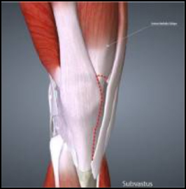 artrotomia subvastus, tecnica minivasiva protesi di ginocchio
