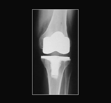 cenni storici della protesi di ginocchio