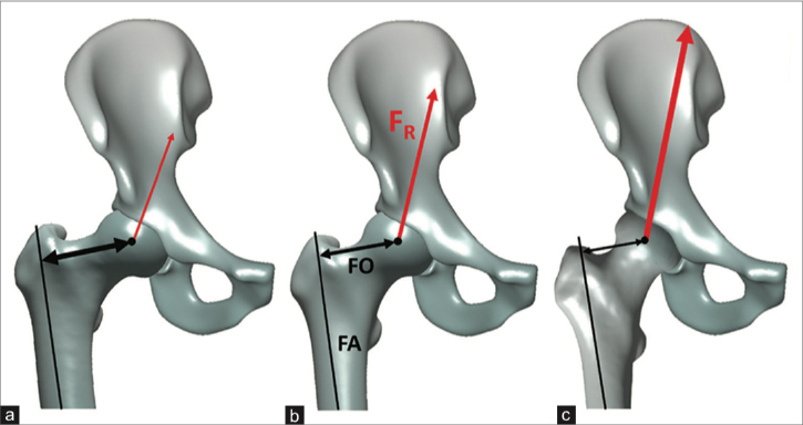 il concetto biomeccanico statico dell'anca