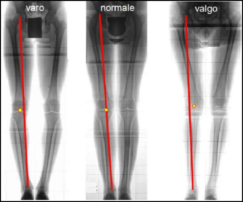 deformità del ginocchio, terapia altenativa protesi ginocchio
