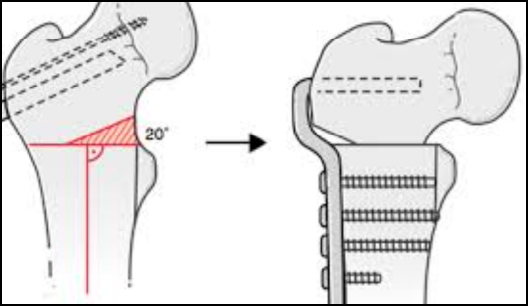 intertrocanterica, osteotomia del femore prossimale