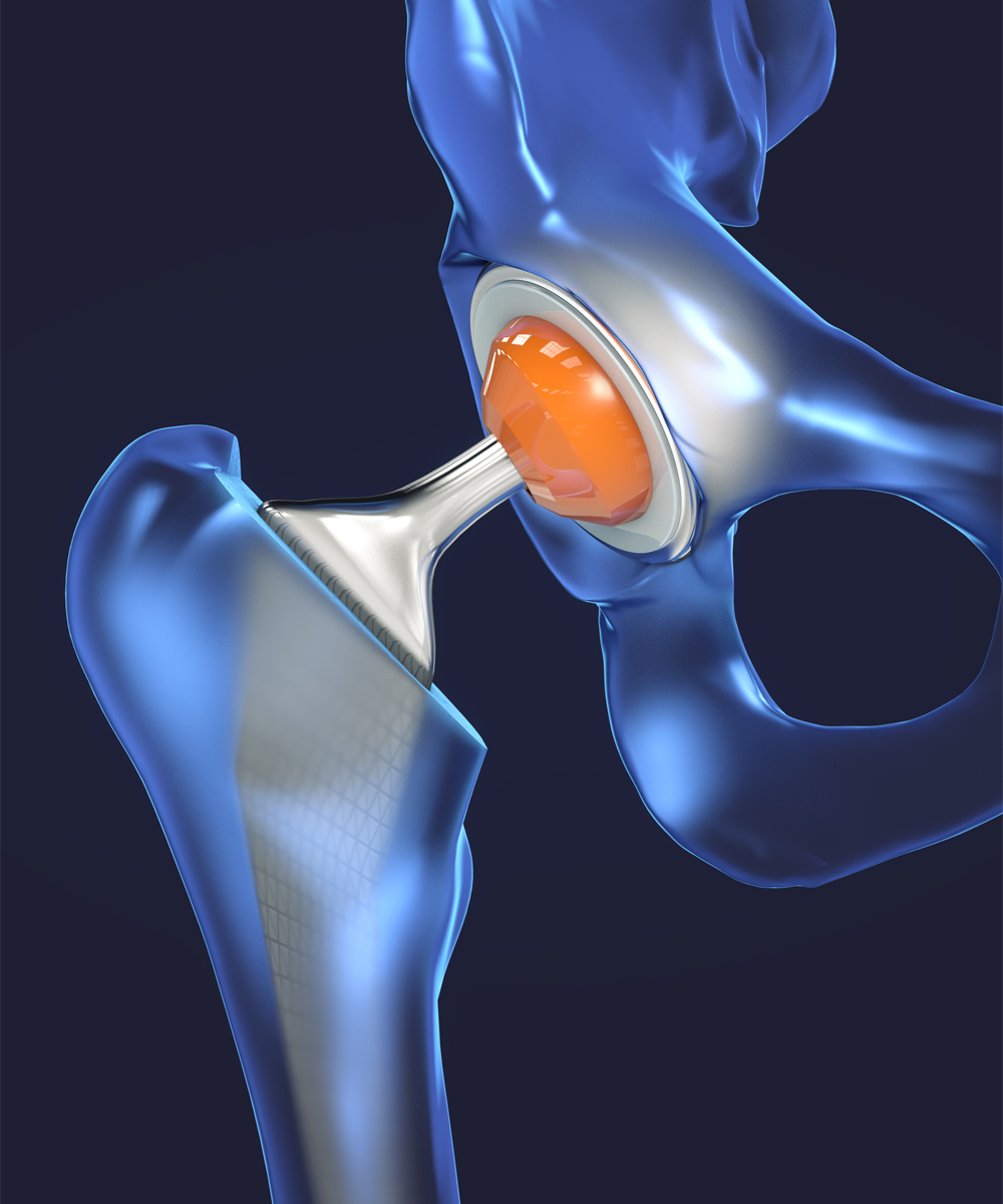 interventi di chirurgia protesica di anca