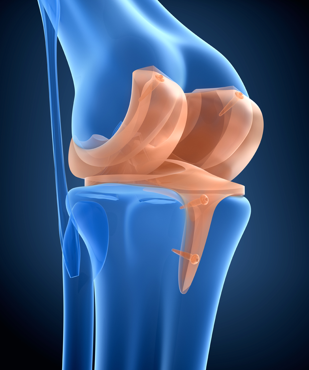 interventi di chirurgia protesica di ginocchio