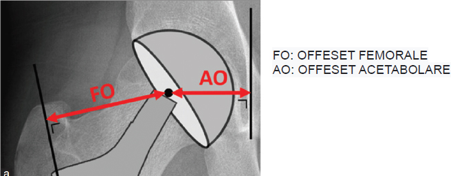 la componente acetabolare nell'anca