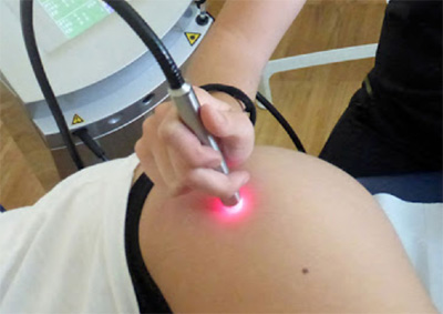 laserterapia, post intervento protesi anca