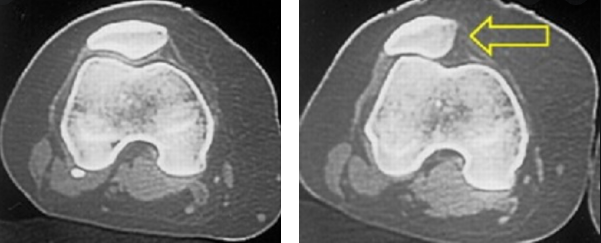 lateral release artrocopico, terapia chirurgica alternativa a intervento chirurgico ginocchio