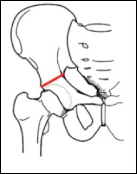 osteotomia di chiari