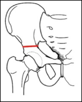 osteotomia innominata di salter