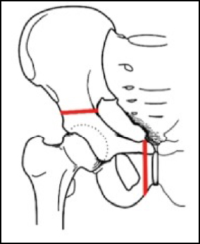 osteotomia innominata doppia