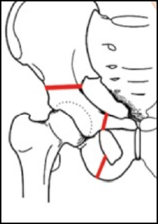 osteotomia innominata tripla