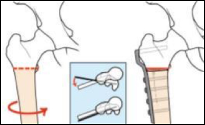 osteotomia intertrocanterica varizzante