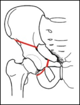 osteotomia periacebatolare o bernese