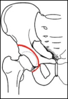 osteotomia periacetabolari sferiche