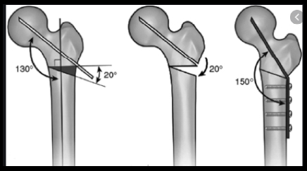 osteotomie valgizzanti femorali