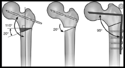 osteotomie varizzanti/valgizzanti femorali