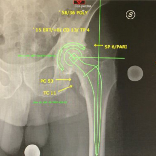 pianificazione computerizzata preoperatoria