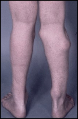 presenta esostosi, intervento protesi ginocchio