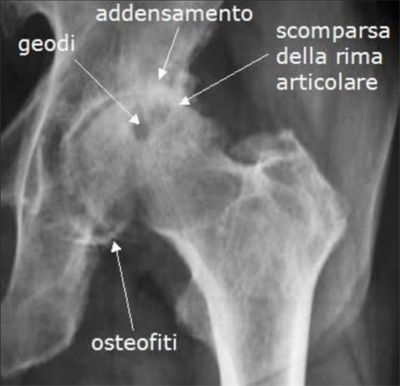 radiografia sotto carico intervento protesi di anca