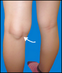 regione rotula e poplitea, intervento protesi ginocchio