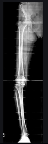 rx arto inferiore in toto sotto carico, intervento protesi ginocchio