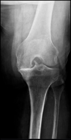 rx postero e anteriore, intervento protesi ginocchio