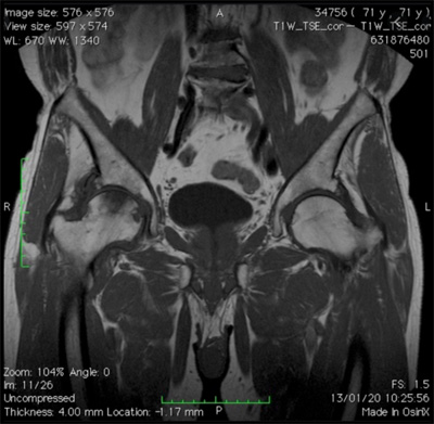 scintigrafia ossea anca bacino per intervento protesi